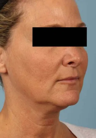 After This 52 year-old Atlanta woman wanted a more youthful contour to her face, as well as smoother lines and brighter skin.  She has eMatrix sublative skin treatments, and she had 3 syringes of Voluma in her cheeks, and one syringe of Juvederm Ultra Plus in her nasolabial folds (smile lines).