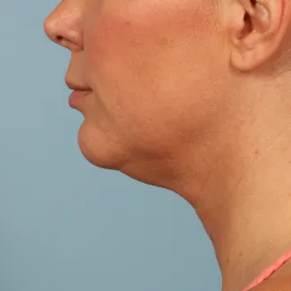 After Results after 3 Kybella treatments