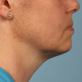 After Shown after a single treatment with Kybella