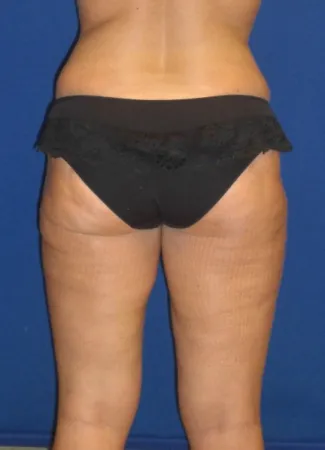 After This woman had an abdominoplasty (tummy  tuck) at the same time as liposuction of her hips, waist, and inner and outer thighs.