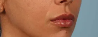 After After 1 syringe of Juvederm Ultra Plus to lips