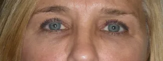 Before Upper eyelid blepharoplasty removes the extra skin and fat in the upper eyelid, making the eye appear more open and bright.