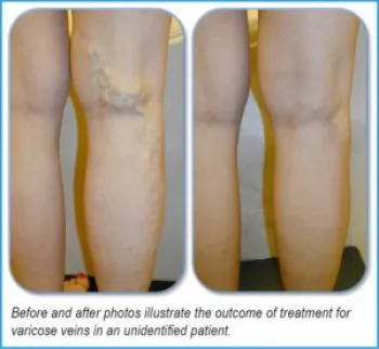 Before and after photos illustrate the outcome of treatment for varicose veins in an unidentified patient.