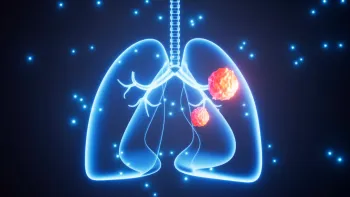 Digital illustration of human lungs highlighting tumors with glowing blue background and particles.