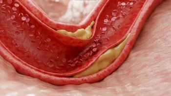 Cross-section of an artery showing plaque buildup and restricted blood flow with red blood cells inside the vessel.