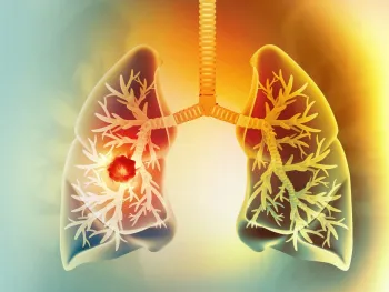 Illustration of human lungs with highlighted tumor inside left lung showing respiratory anatomy and disease.