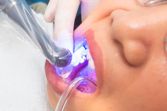 Close-up of dental procedure using blue curing light on a patient's molar with dental tools in mouth