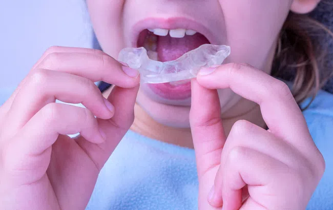 Child inserting a clear dental retainer or mouthguard into their open mouth, close-up view.