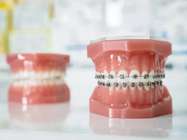 Dental models showing teeth with metal braces and a blurred model without braces in the background.