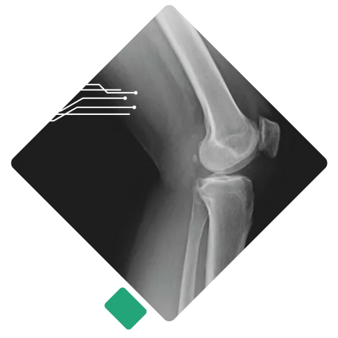 X-ray image showing a human knee joint highlighting bones and joint structure in grayscale.