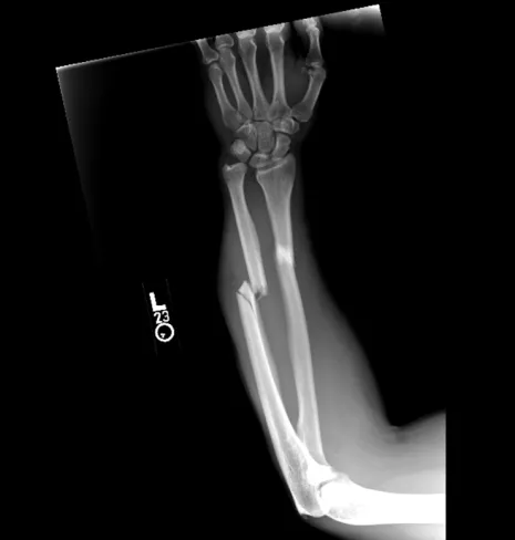 X-ray of a forearm showing a clear fracture in the radius bone near the wrist on the left arm.