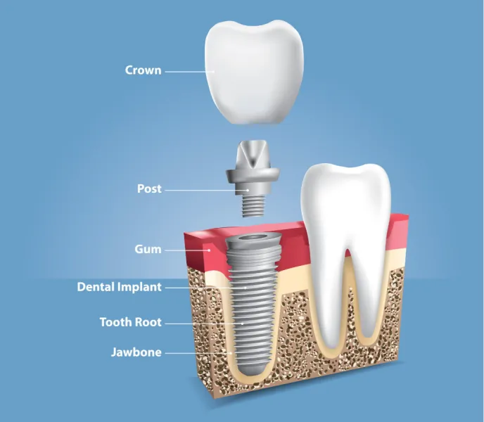 diagram of a dental implant