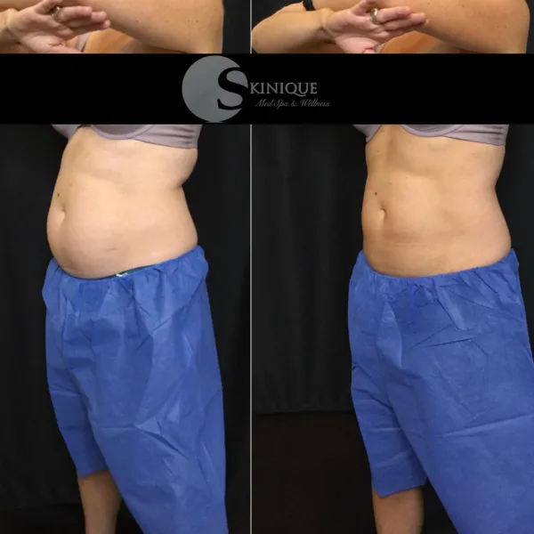 Coolsculpting abdomen results