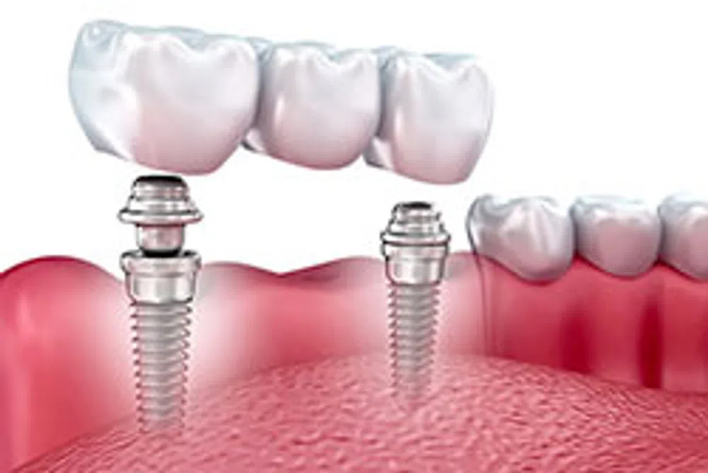 dental implants