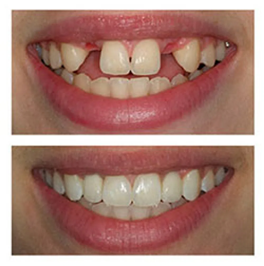 Before and after dental restoration
