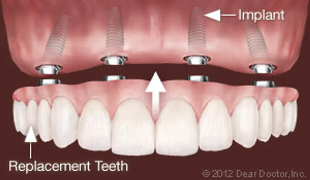 Dental implants supporting