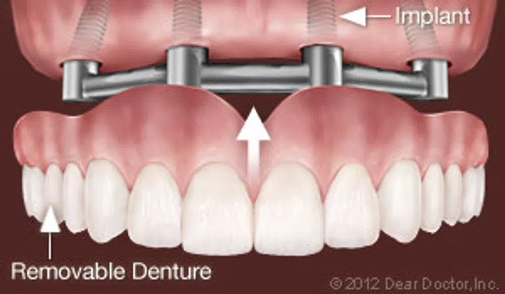 Diagram of implant-supported