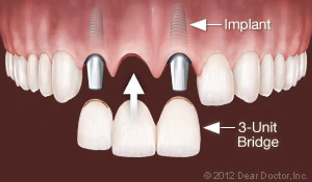Dental implants and 3-unit bridge