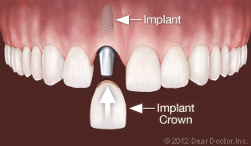 Dental implant and crown