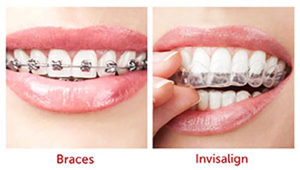 lose-up comparison of teeth with metal braces versus clear Invisalign aligners on smiling lips