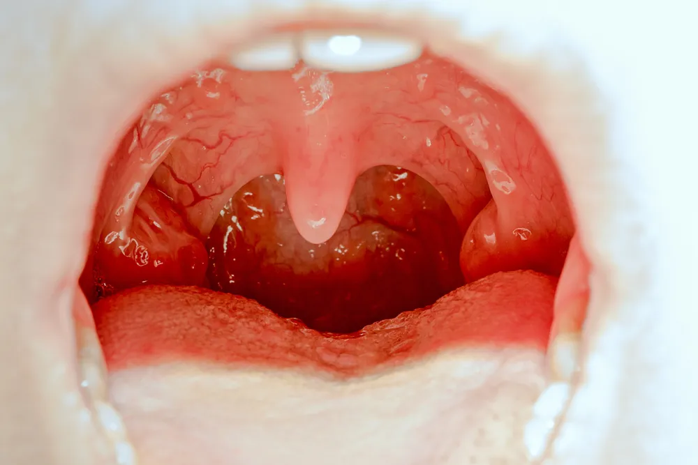 tonsillectomy and adenoidectomy post op