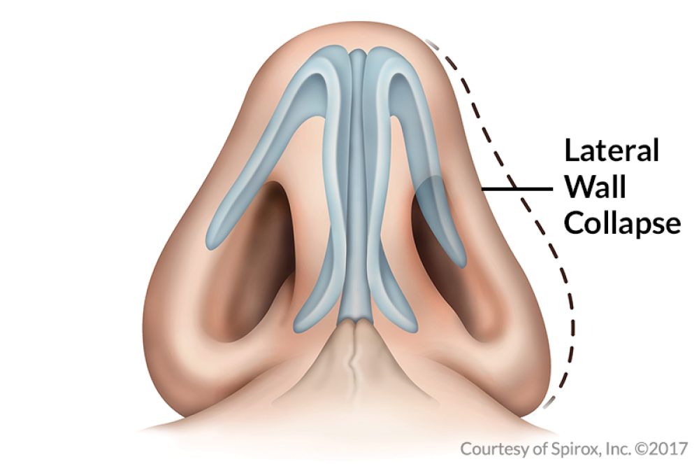 One sided store blocked nose