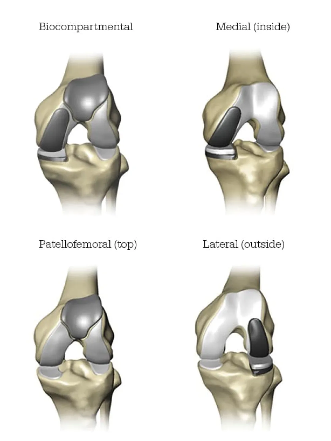 Robot Assisted Knee Replacement Near Me In Lexington Ky Knee Surgeons Bluegrass Orthopaedics