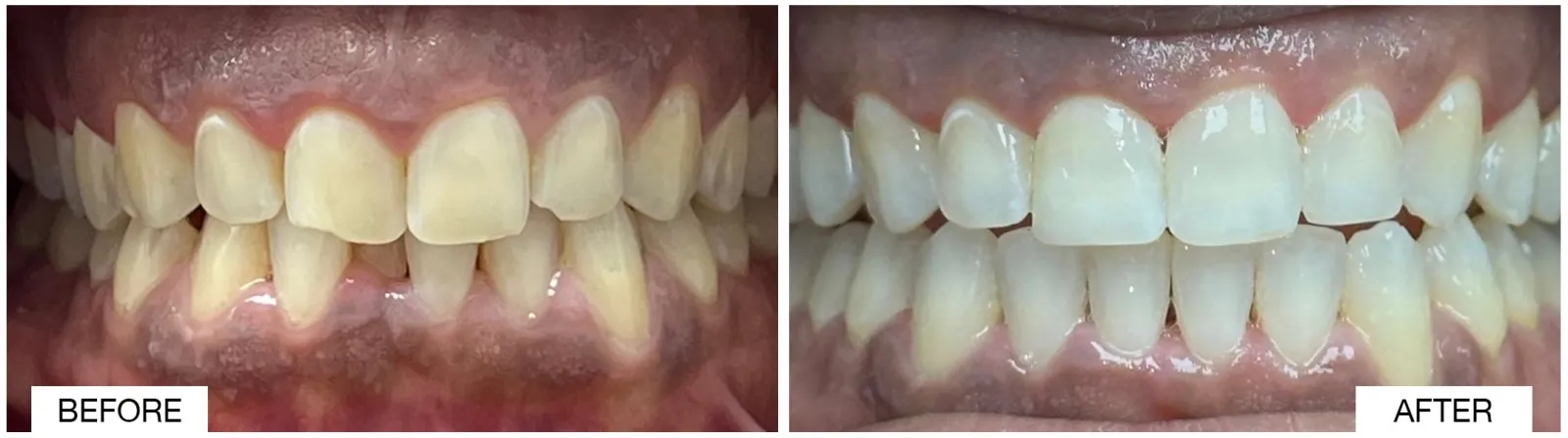 Comparison of teeth before and after whitening, showing significant improvement in color and appearance.
