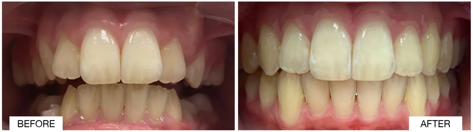 Comparative dental transformation showing teeth before and after whitening treatment.