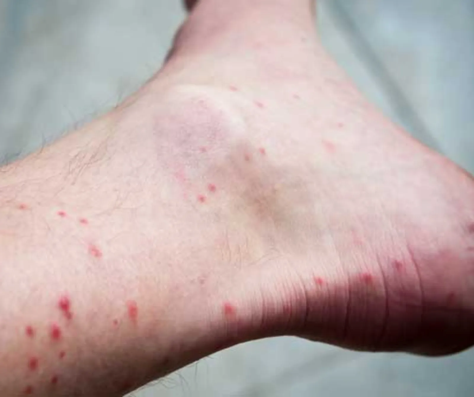 image of flea bites on a person's leg