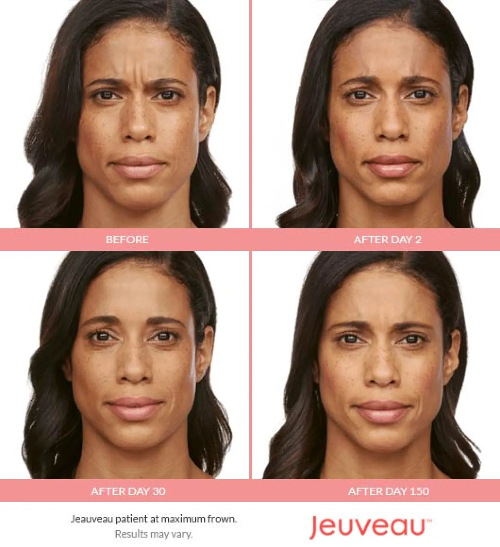 Best Jeuveau Atlanta Case Study 4 Facial Aesthetic Surgery