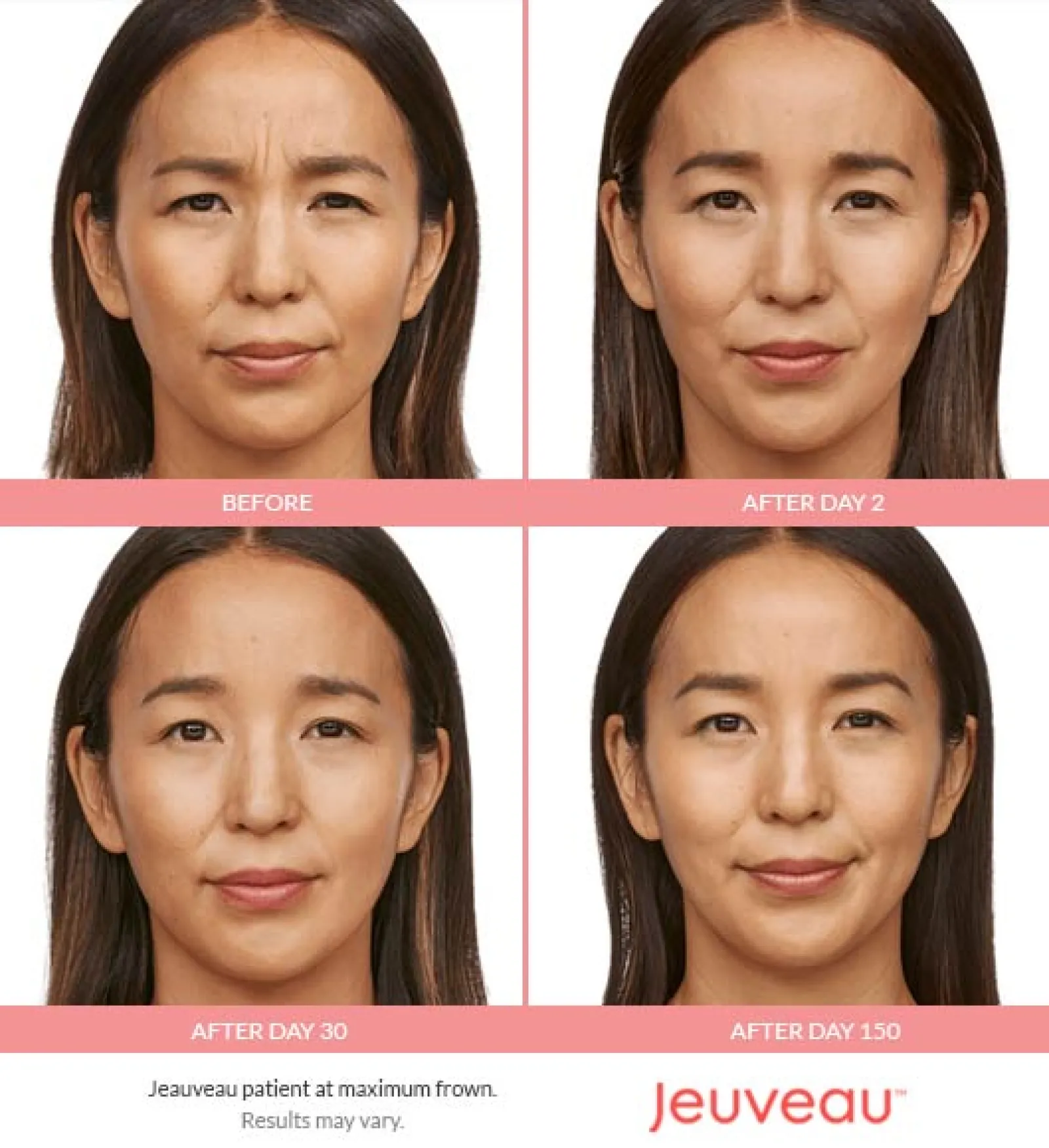 Best Jeuveau Atlanta Case Study 2 Facial Aesthetic Surgery
