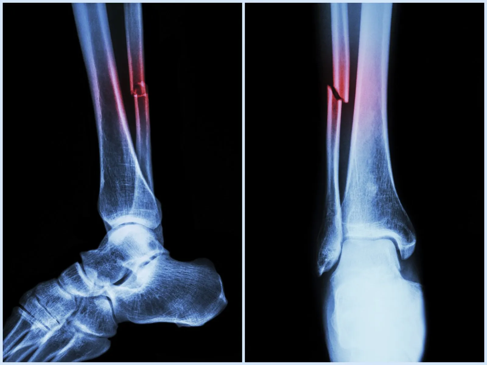 Non Surgical vs. Surgical Treatment of Fractures Orthopaedic