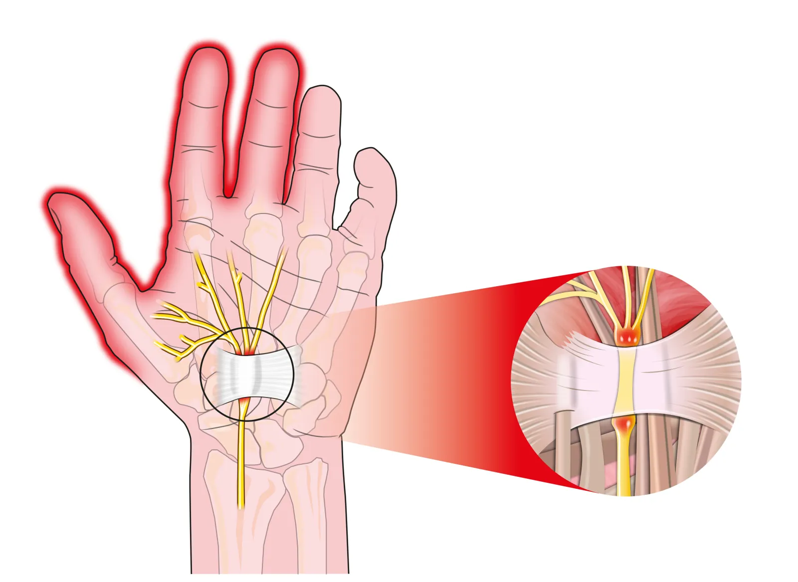 Carpal tunnel release