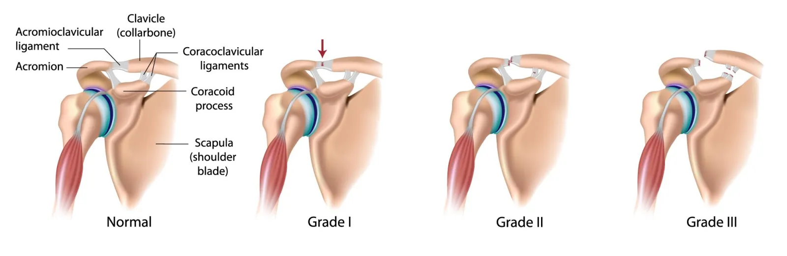 Separated Shoulder, AC Joint Separation