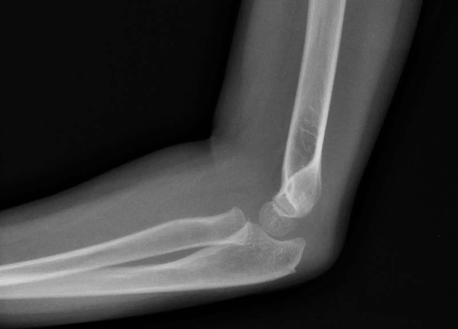 elbow x-ray