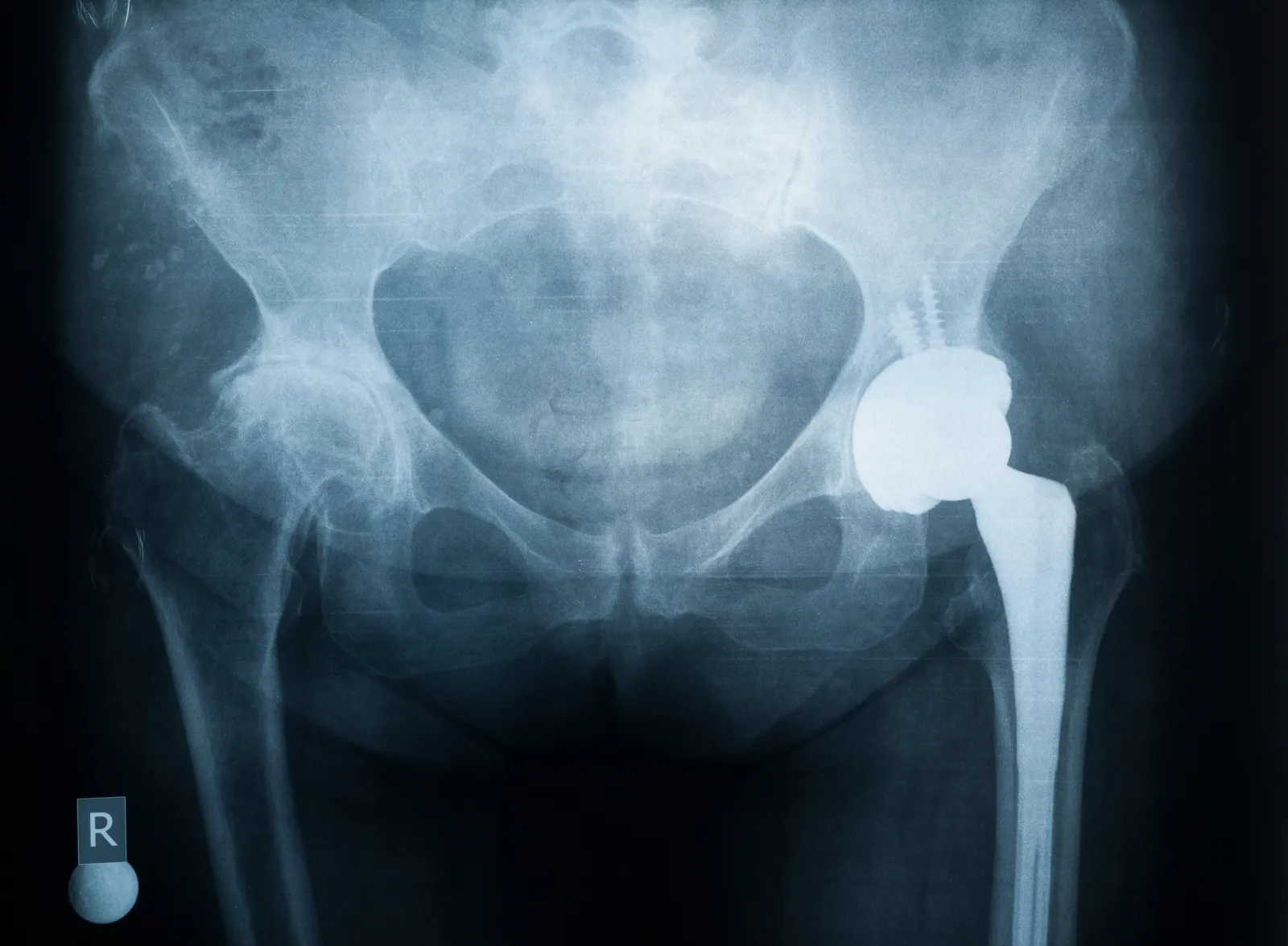 hip x-ray
