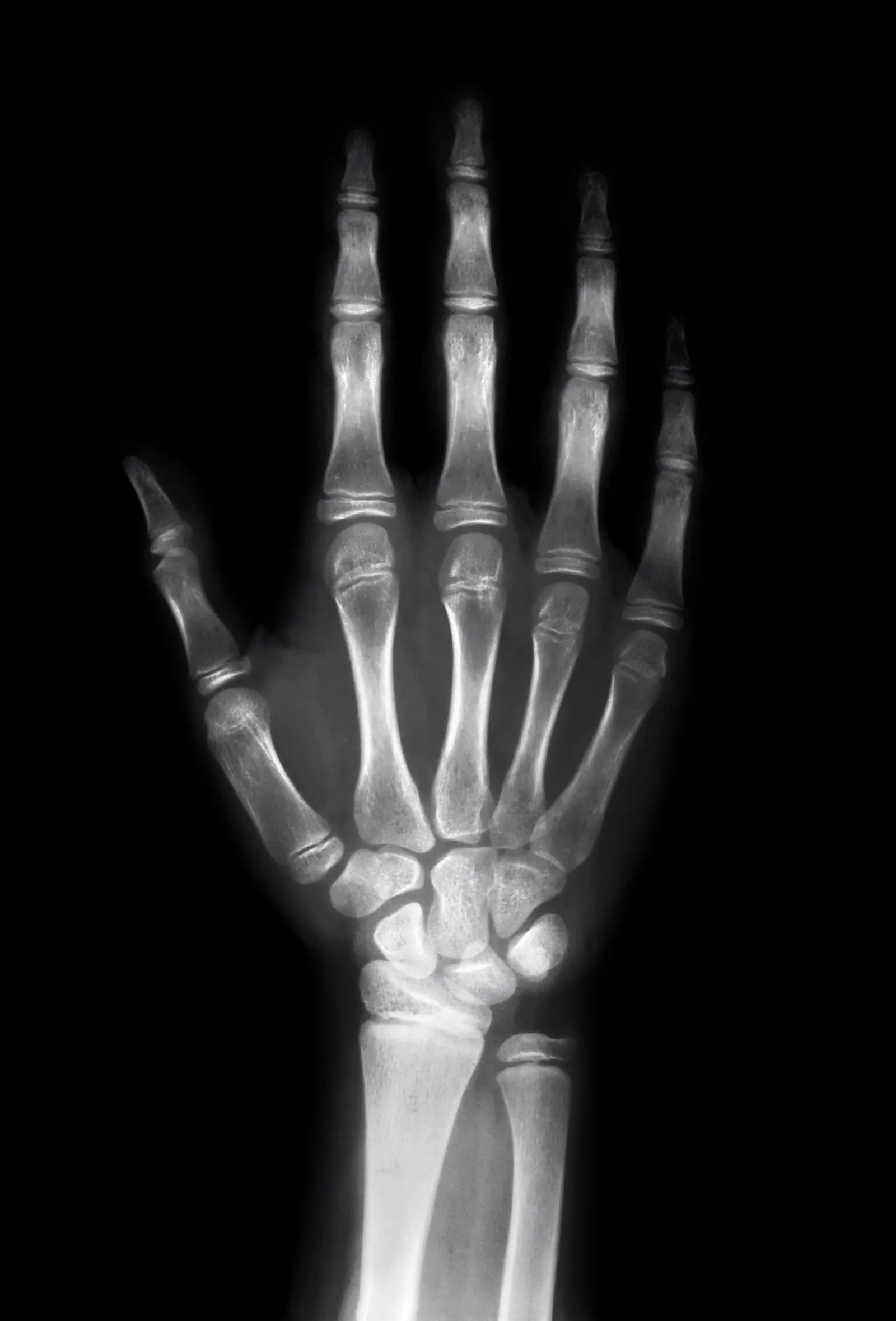 hand x-ray