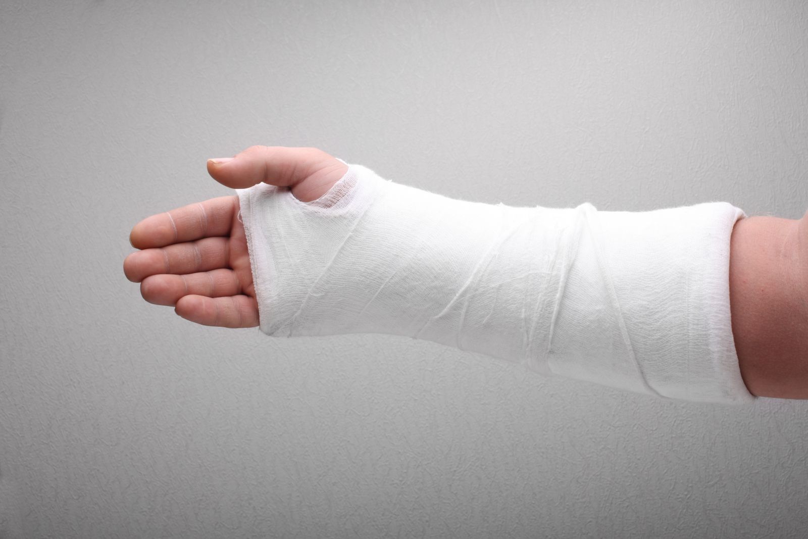 Everything You Need to Know About Arm Casts