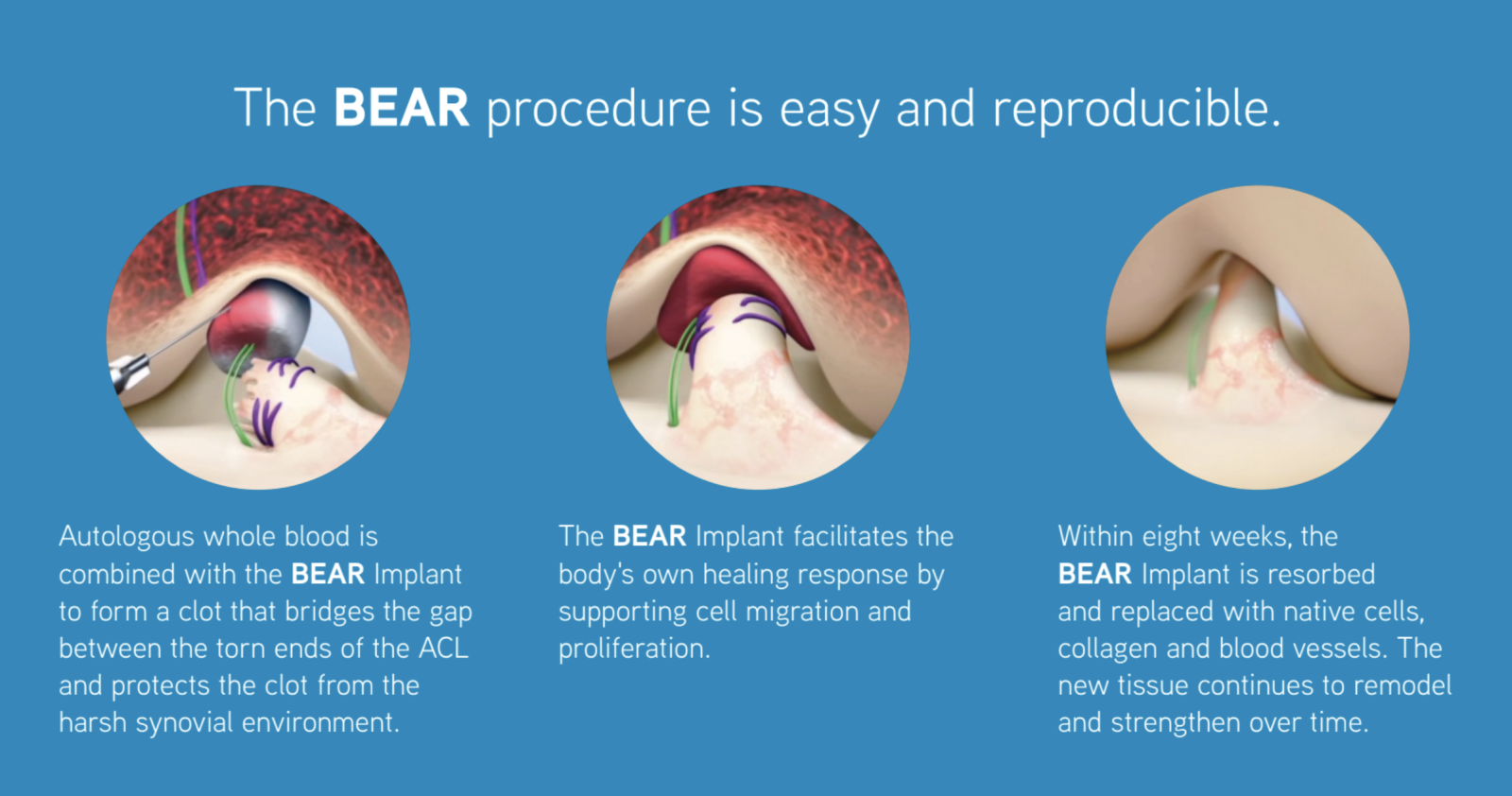 Bridge Enhanced ACL Restoration (BEAR Implant) | Pinnacle Orthopaedics