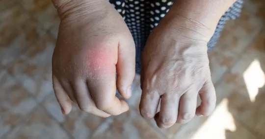 Close-up of hands showing swollen and inflamed knuckle on left hand indicating possible arthritis or injury.