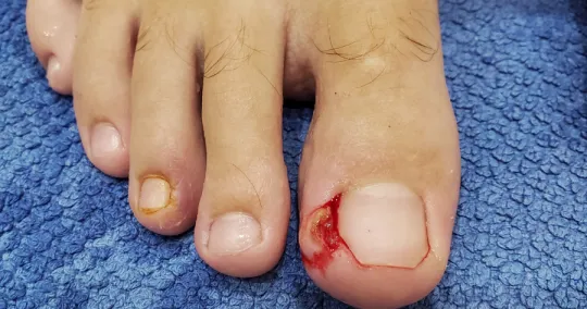 Close-up of toes with an inflamed, bleeding toenail and signs of infection on a blue towel.