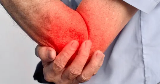 Person holding their painful, inflamed elbow with redness indicating joint pain or injury.