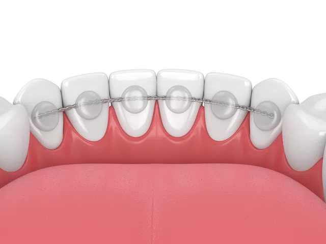 Close-up of lower teeth with lingual braces and wire attached to the back of teeth inside the mouth.