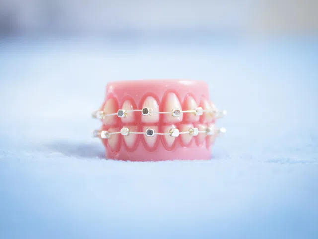 Dental model with metal braces on teeth displayed on a soft blue surface.