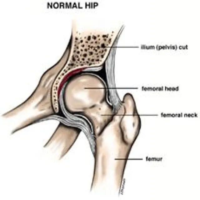 Anatomical diagram of a normal human hip showing pelvis cut, femoral head, neck, and femur labeled.