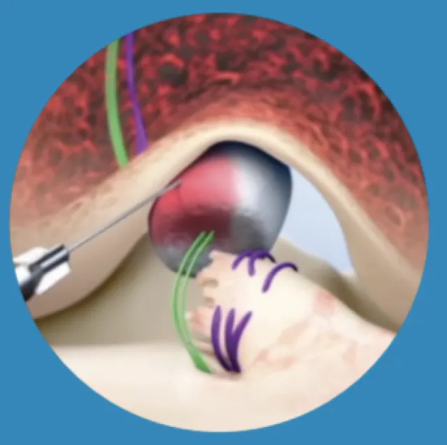 Three-step illustration of the BEAR procedure showing clot formation, cell migration, and tissue remodeling for ACL repair.