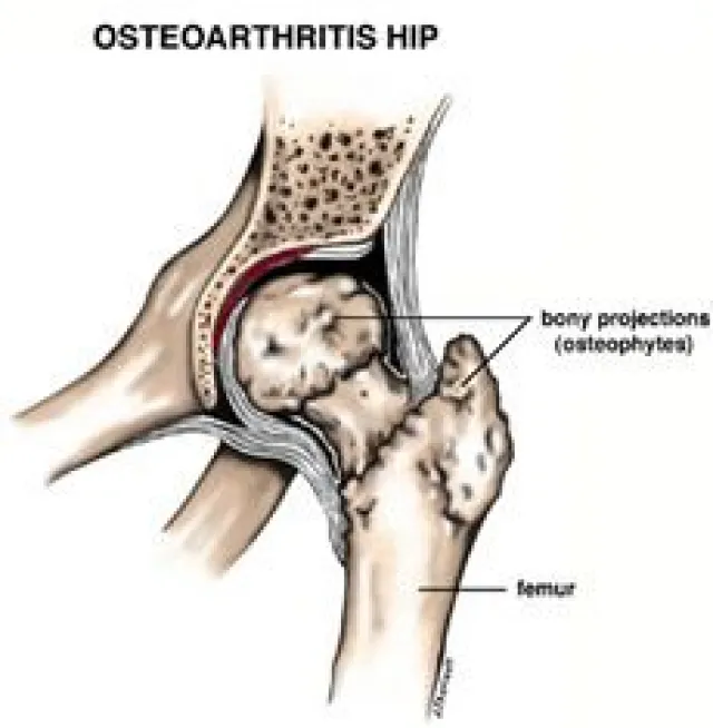 Medical illustration of osteoarthritis in the hip showing femur and bony projections called osteophytes.