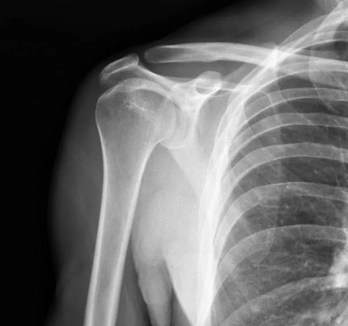 How Resurgens Diagnoses Shoulder Pain