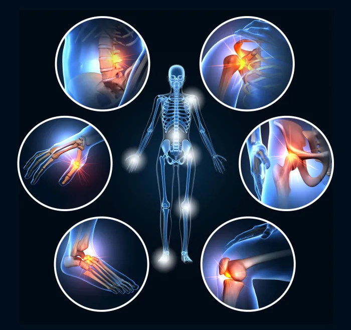 Joint Counts and Rheumatoid Arthritis